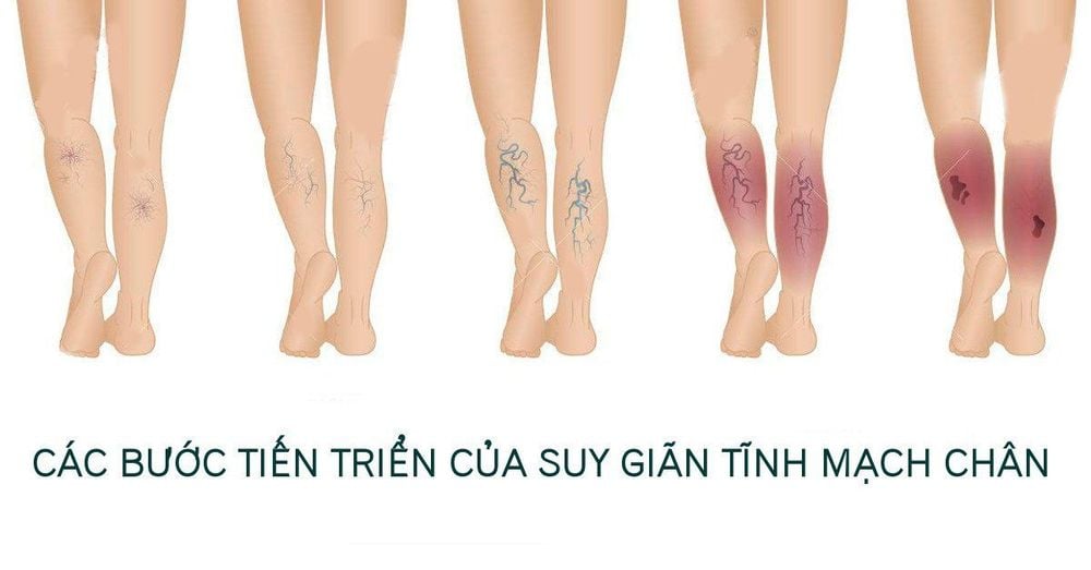 Suy giãn tĩnh mạch chân