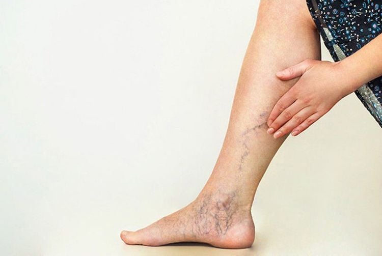 Biểu hiện suy giãn tĩnh mạch chân