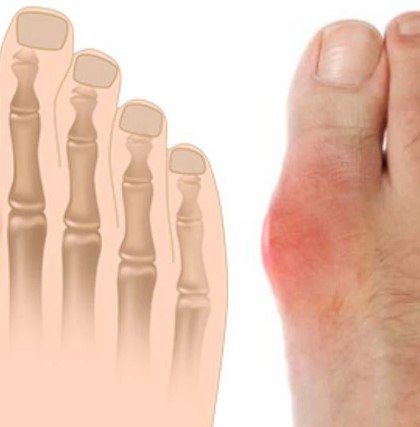 gout